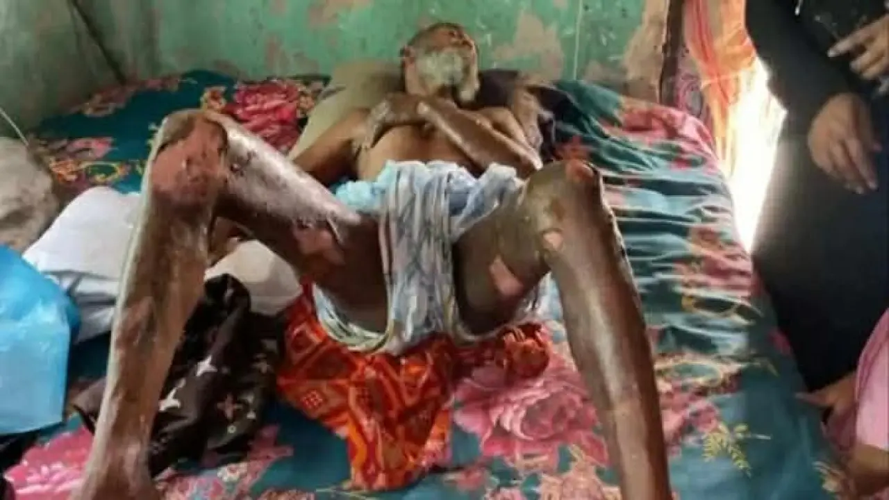 রাঙ্গাবালীতে ছেলে কে বাঁচাতে গিয়ে বাবার শরীর দগ্ধ