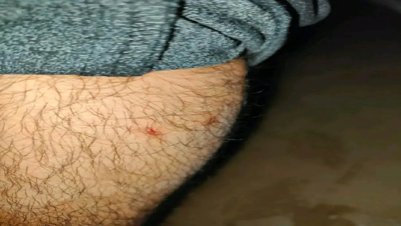 যবিপ্রবিতে কুকুরের কামড়ে আহত এক শিক্ষার্থী, আতঙ্কে শিক্ষক-শিক্ষার্থীরা